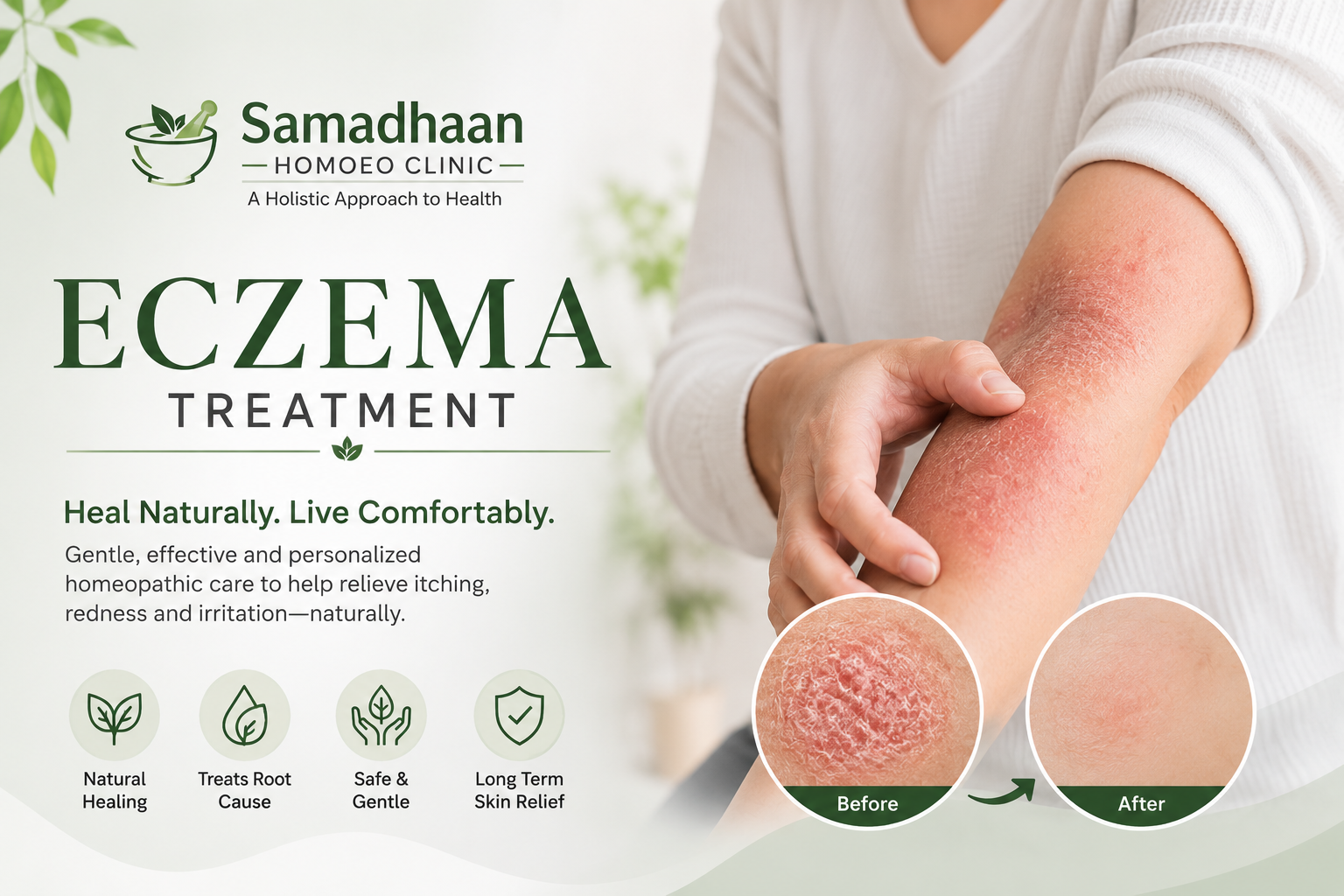Homeopathy treatment for eczema in Lucknow with personalized skin care