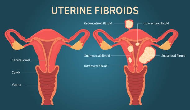Illustration showing different types of uterine fibroids and homeopathy treatment in Lucknow